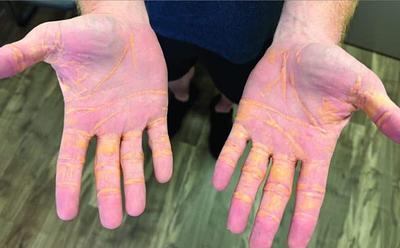 What Are ‘Cheese Hands’? The Carnivore Diet Symptom Making Headlines